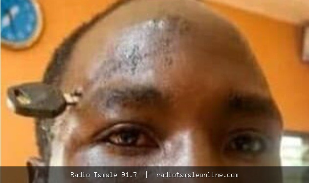 Doctors successfully remove motorbike key from skull of farmer who was stabbed during an attempt to stop a fight